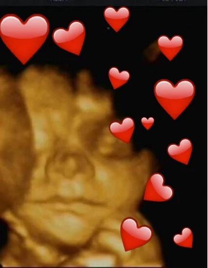 microquimerismo fetal en un ecografia